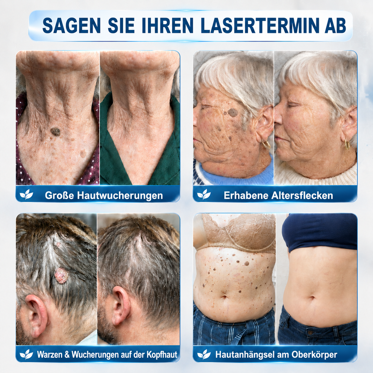 HISKIN®🇩🇪7-Tage-Hautmakel- & Hautanhängsel-Entferner💧Schmerzfreier Rollerball-Stift zur schonenden Entfernung von Hautanhängseln und Hautflecken – narbenfrei