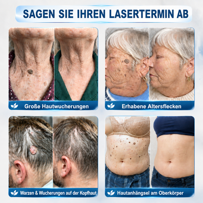 HISKIN®🇩🇪7-Tage-Hautmakel- & Hautanhängsel-Entferner💧Schmerzfreier Rollerball-Stift zur schonenden Entfernung von Hautanhängseln und Hautflecken – narbenfrei