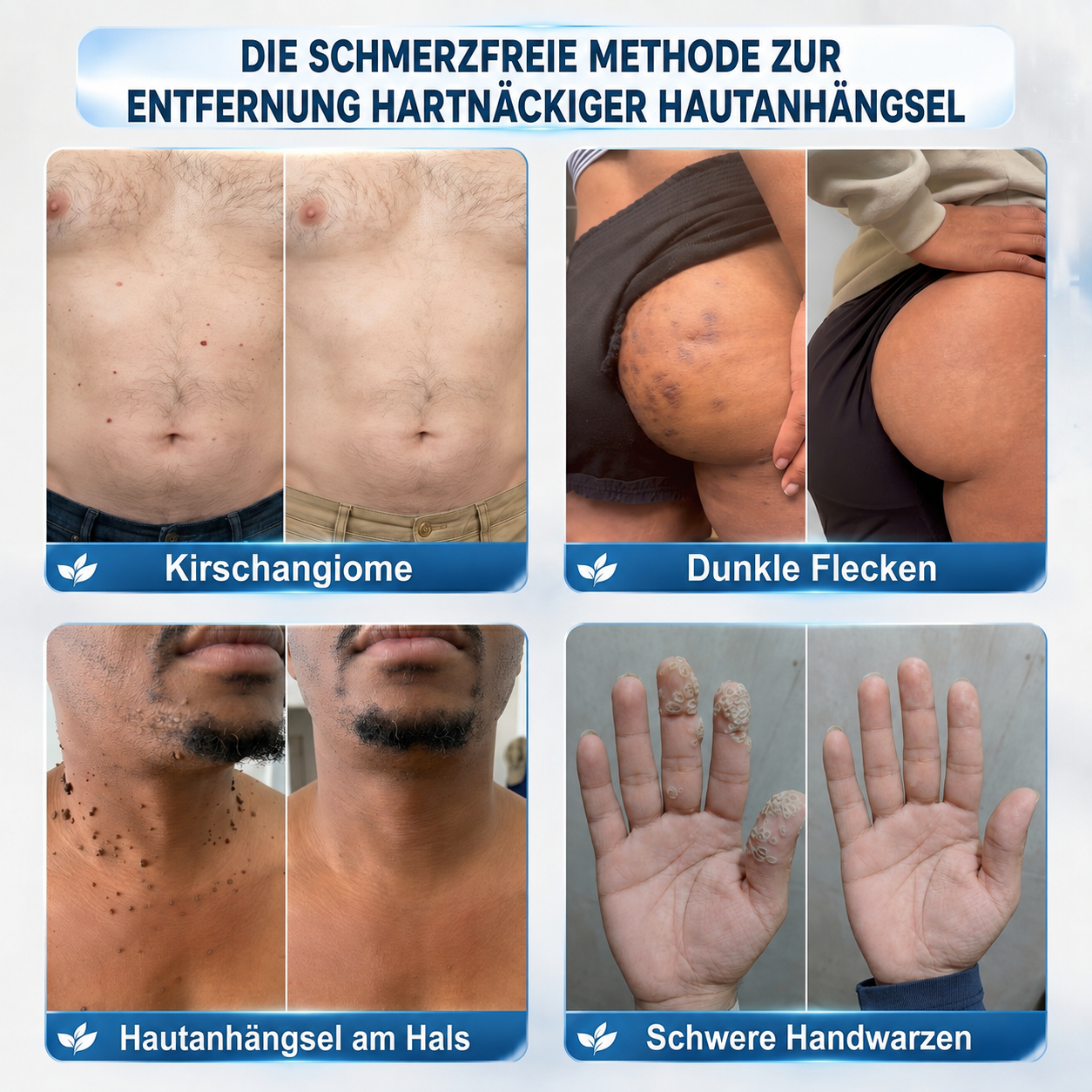 HISKIN®🇩🇪7-Tage-Hautmakel- & Hautanhängsel-Entferner💧Schmerzfreier Rollerball-Stift zur schonenden Entfernung von Hautanhängseln und Hautflecken – narbenfrei