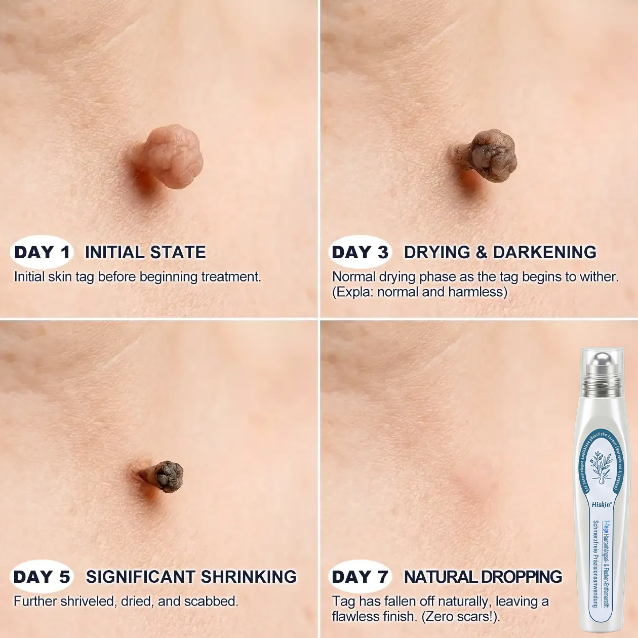 HISKIN®🇩🇪7-Tage-Hautmakel- & Hautanhängsel-Entferner💧Schmerzfreier Rollerball-Stift zur schonenden Entfernung von Hautanhängseln und Hautflecken – narbenfrei