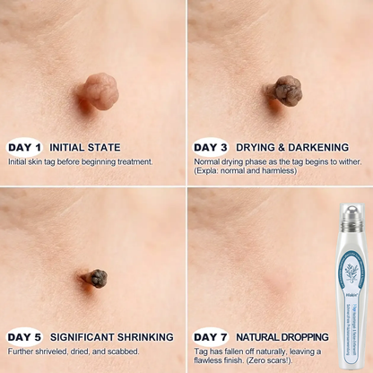 HISKIN®🇩🇪7-Tage-Hautmakel- & Hautanhängsel-Entferner💧Schmerzfreier Rollerball-Stift zur schonenden Entfernung von Hautanhängseln und Hautflecken – narbenfrei